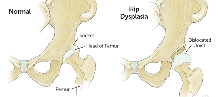 the different between a normal hip and a disclocted hip for hip dysplasia